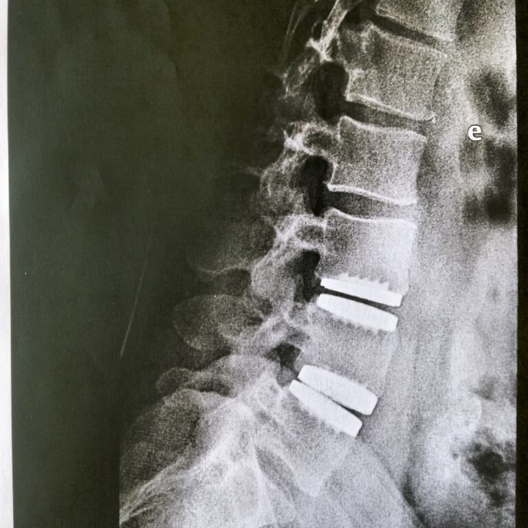 neuro estimulador medular